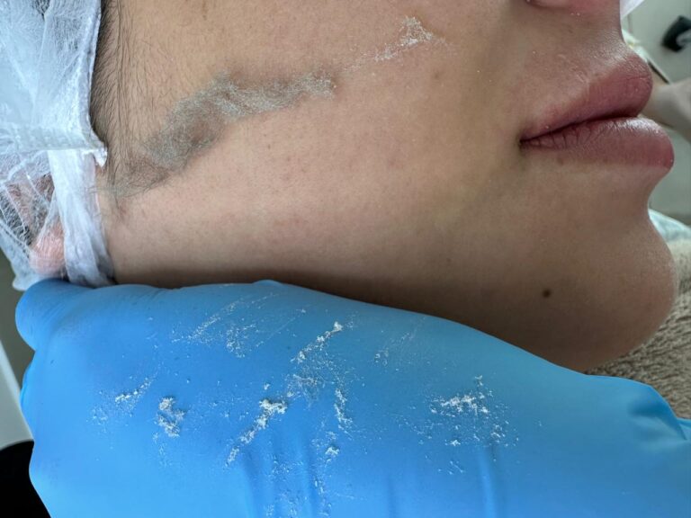 Dermaplaning (1)